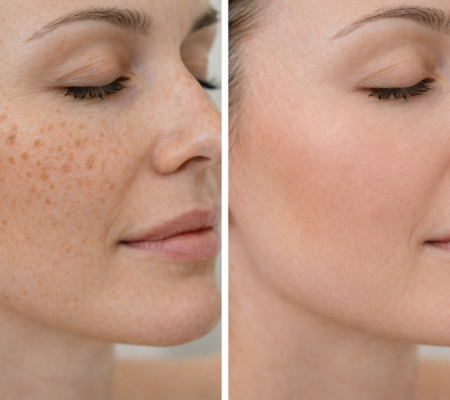 лечение пигментации